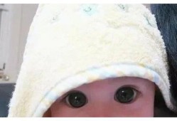 吃葡萄胎儿眼睛大（吃葡萄胎儿眼睛大吗）
