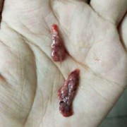流产后的胎儿（清宫做完后复查还有残留，怎么办好呢）