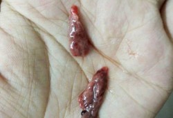 流产后的胎儿（清宫做完后复查还有残留，怎么办好呢）