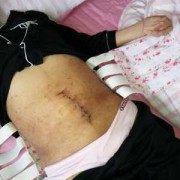 胎儿37周可以剖腹产吗（37周做剖腹产对孩子有影响吗）