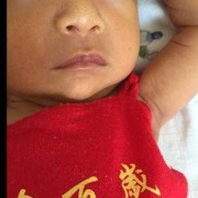 胎儿唇发育（婴儿嘴周围发青）