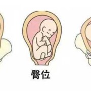 l和p哪个是左,胎儿头位lop是什么意思
