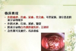 孕期阴道炎反复（孕期霉菌性阴炎反反复复怎么办）