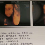 胎儿bdp是什么意思（B超各字母代表什么）