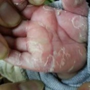 梅毒孕妇生下的孩子会怎样,孕期角膜炎对胎儿有影响吗