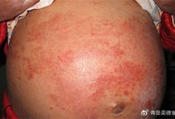孕妇湿疹的症状有哪些,孕期湿疹有什么症状图片