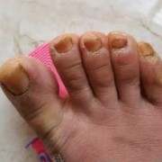 孕期得灰指甲（孕期得灰指甲）