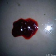 大便出血对胎儿有影响吗（怀孕37周大便带血对胎儿有影响吗）