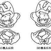 胎儿左枕横位图片（怀孕七个月横位怎么办？我该为宝宝做的措施是什么）