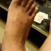 孕妇脚上会有湿疹是怎么回事,孕期脚上湿疹怎么办啊