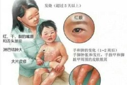 胎儿嘴唇裂（婴儿嘴巴热怎么办呢？是发烧的症状吗）