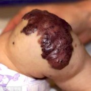 先天性血管畸形能彻底治好吗,胎儿畸形的10大征兆