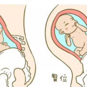 胎儿臀位图（胎儿臀位图片）