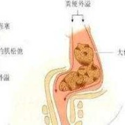 孕期用力大便阴唇肿大（孕妇用力大便阴嘴膨出躺着能恢复吗）