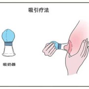 孕期乳头内陷怎么办？这是什么情况啊,孕期乳头矫正器矫正凹陷乳头流水是怎么回事 怎么办
