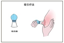 孕期乳头内陷怎么办？这是什么情况啊,孕期乳头矫正器矫正凹陷乳头流水是怎么回事 怎么办