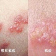 儿童病毒性疱疹传染吗？邻居孩子生病了，需要怎么避免传染的呢,孕妇得带状疱疹会传染给胎儿吗