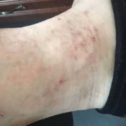 孕期脚踝痒（孕期脚踝痒是怎么回事）
