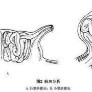 胎儿脐膨出自己长好了（脐膨出是什么原因引起的）