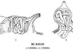 胎儿脐膨出自己长好了（脐膨出是什么原因引起的）