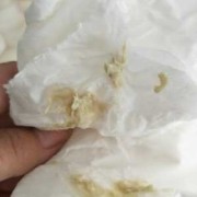 怀孕期间白带发黄怎么回事,