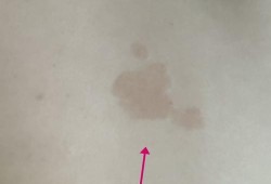 孕期胸部长斑（孕期胸部长斑点是什么原因）
