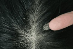孕期乳晕上长黑色硬痂（孕期乳晕上长黑色硬痂怎么回事）