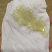 孕期白带变绿（白带发黄发绿什么原因）