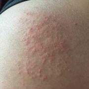 孕妇为什么会得湿疹,孕期湿疹止痒最有效的方法