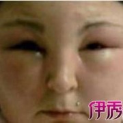 胎儿水肿有什么症状（两岁的宝宝眼皮浮肿需要做哪些检查）