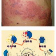孕期带状疱疹如何治疗,孕期带状疱疹对胎儿的影响