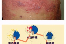 孕期带状疱疹如何治疗,孕期带状疱疹对胎儿的影响