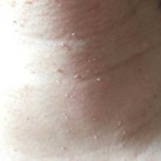 怀孕期间脖子上长肉丁（怀孕期间脖子上长肉丁怎么回事）