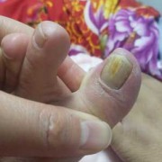 孕期得灰指甲（孕期得灰指甲）