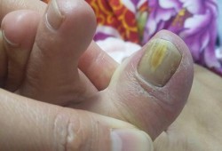 孕期得灰指甲（孕期得灰指甲）