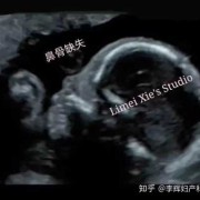 12周胎儿鼻骨缺失是畸形吗,胎儿鼻骨缺失是畸形吗图片