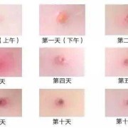 怀孕期间出水痘怎么办（怀孕期间出水痘怎么办呢）
