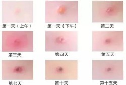 怀孕期间出水痘怎么办（怀孕期间出水痘怎么办呢）