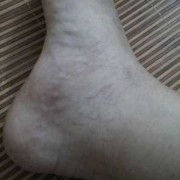 孕期脚踝肿了怎么办（孕妇脚和脚腕有红血丝）