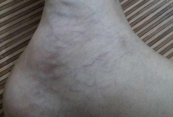孕期脚踝肿了怎么办（孕妇脚和脚腕有红血丝）