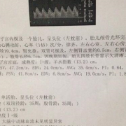 胎儿b超数据标准对照表（胎儿侧脑室宽度正常值是多少）