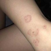 孕期有皮炎怎么办（谁知道孕妇的腿上脱皮比较严重，应该怎么办）