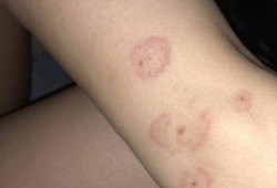 孕期有皮炎怎么办（谁知道孕妇的腿上脱皮比较严重，应该怎么办）