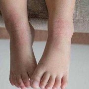 孕期腿手肿（孕期腿肿手肿）