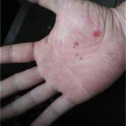 孕期手足湿疹（孕期手足湿疹太痒了怎么办）