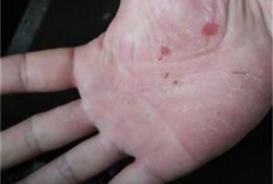 孕期手足湿疹（孕期手足湿疹太痒了怎么办）