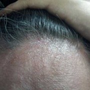 孕期头皮屑（孕期头皮屑特别多怎么办）