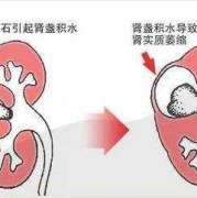 孕晚期胎儿肾积水（孕晚期胎儿肾积水是什么原因引起的）