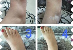 孕期腿脚浮肿（孕妇脚水肿怎么办）