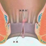 肛裂能怀孕吗,孕期肛裂疼痛如何缓解疼痛